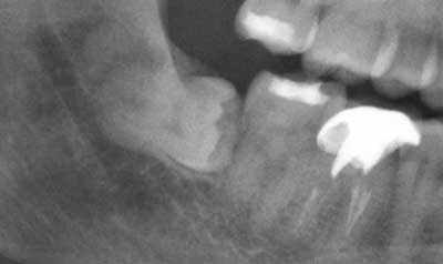 Impacted Wisdom Teeth Removal Cases