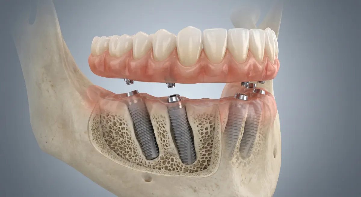 All-on-4 dental implants procedure showing four titanium implants supporting a fixed full-arch prosthesis in the lower jaw
