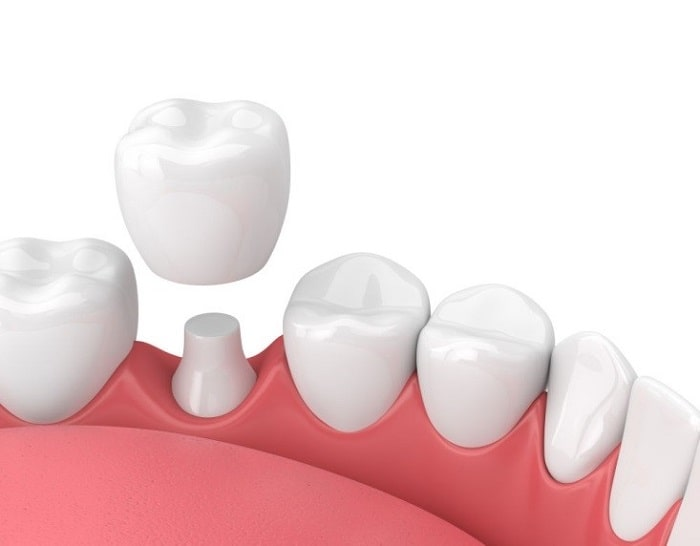 Dental crowns Hamilton, 3D illustration of a porcelain dental crown being placed over a prepared tooth.