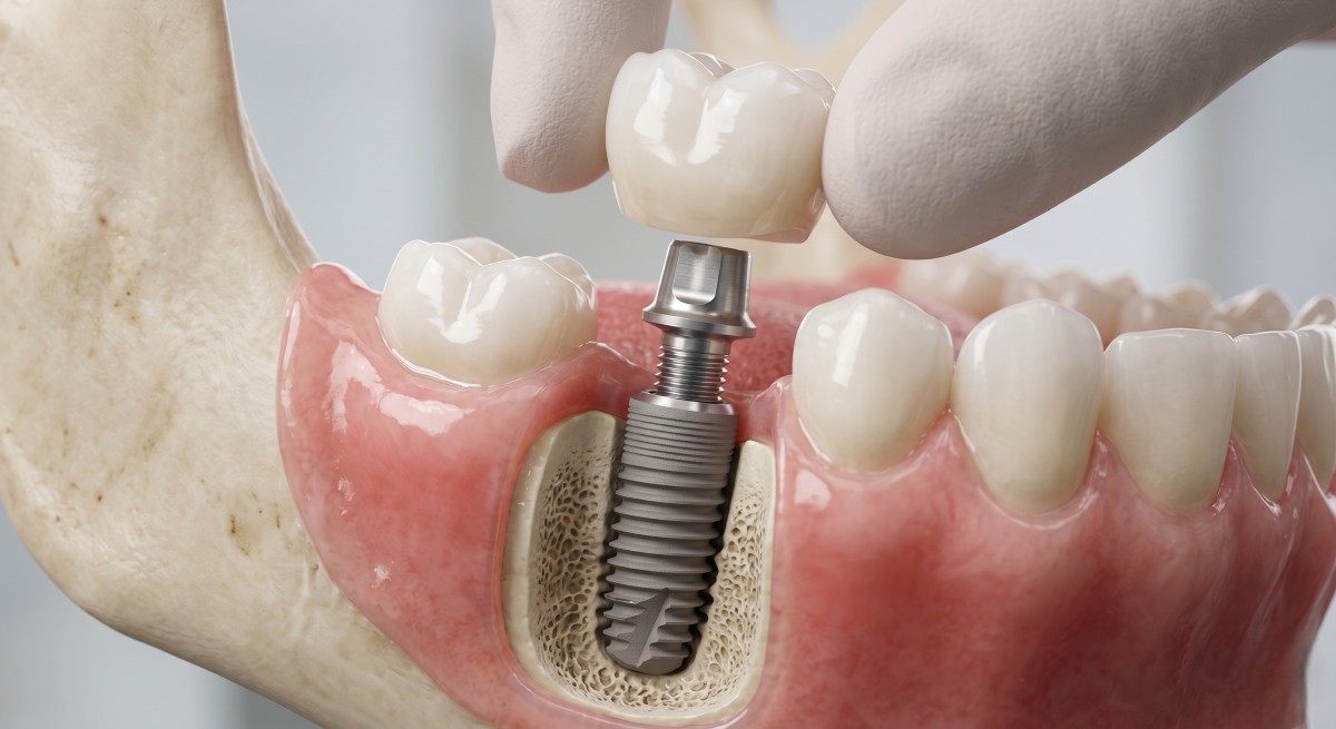 3D anatomical model showing a Dental Implant titanium post fused into the jawbone with a ceramic crown in Hamilton