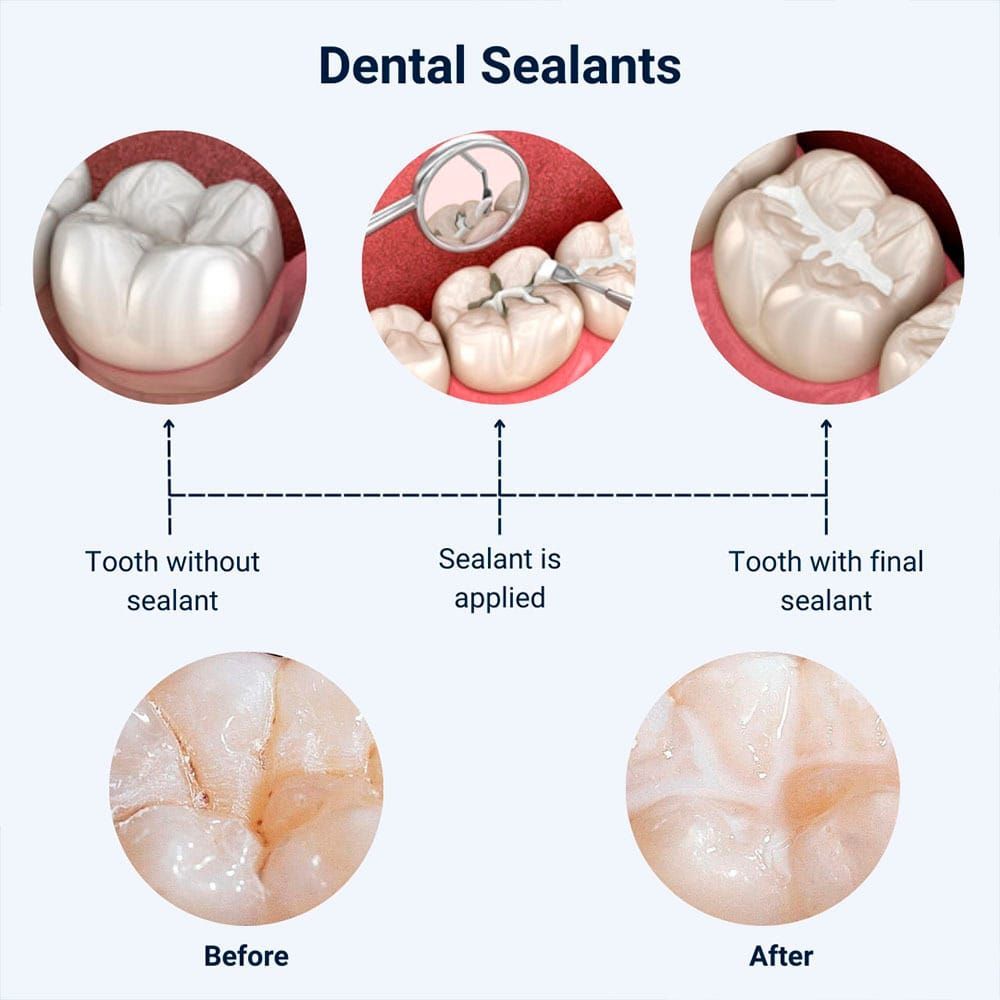 Dental sealants Hamilton, step-by-step procedure showing tooth without sealant, sealant being applied to molar grooves, and tooth with final cured sealant, plus before-and-after close-up of treated chewing surface
