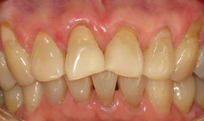 Bonding & Resin Composite Restorations case 100 — before