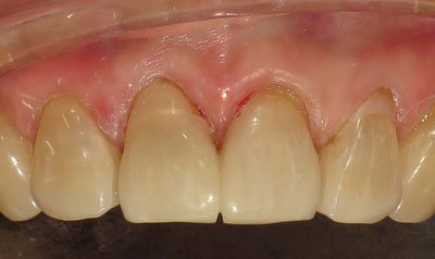 Bonding & Resin Composite Restorations case 100 — after