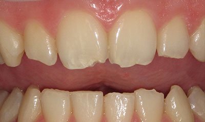 Bonding & Resin Composite Restorations case 103 — before