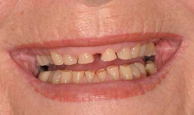 Bonding & Resin Composite Restorations case 11 — before
