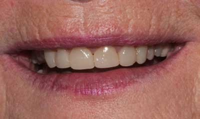 Bonding & Resin Composite Restorations case 11 — after