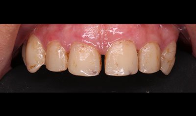 Bonding & Resin Composite Restorations case 113 — before