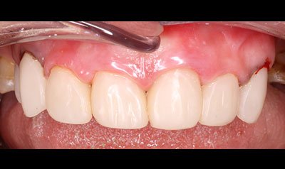 Bonding & Resin Composite Restorations case 113 — after