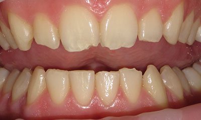 Bonding & Resin Composite Restorations case 114 — before