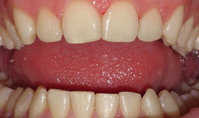 Bonding & Resin Composite Restorations case 114 — after