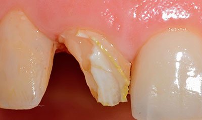 Bonding & Resin Composite Restorations case 118 — before