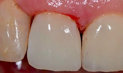 Bonding & Resin Composite Restorations case 118 — after