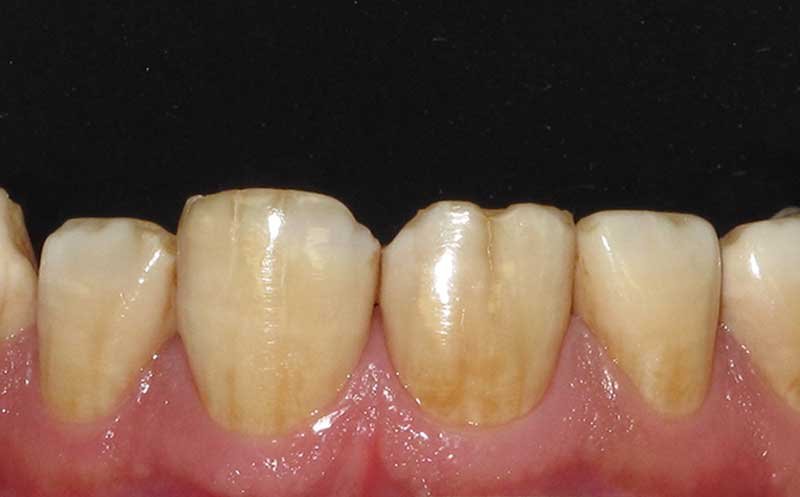 Bonding & Resin Composite Restorations case 122 — before