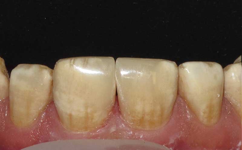 Bonding & Resin Composite Restorations case 122 — after