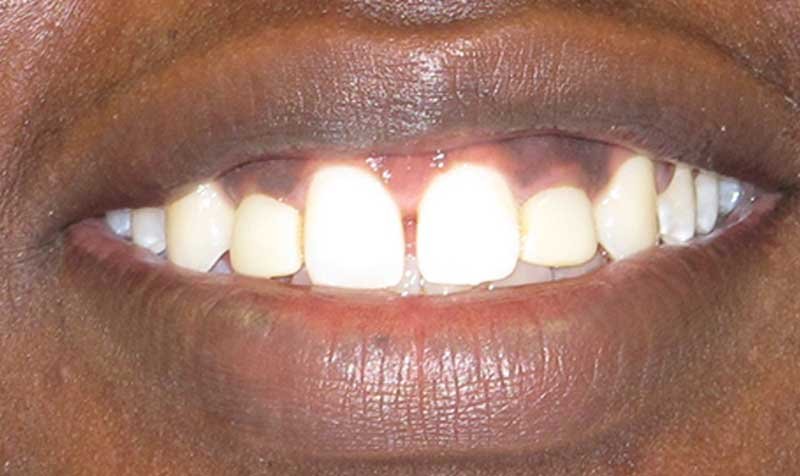 Bonding & Resin Composite Restorations case 123 — before