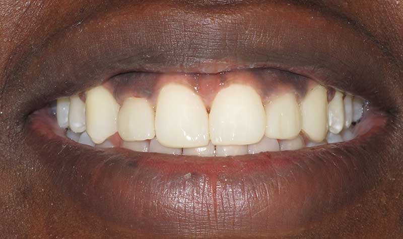 Bonding & Resin Composite Restorations case 123 — after