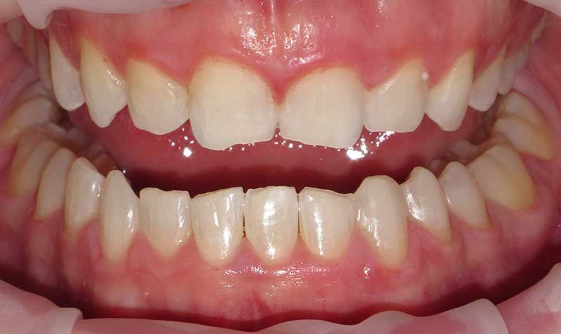 Bonding & Resin Composite Restorations case 129 — before