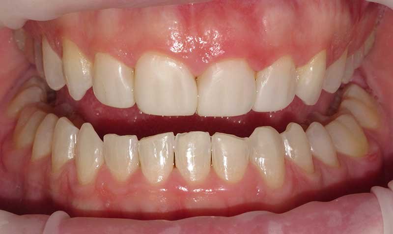Bonding & Resin Composite Restorations case 129 — after