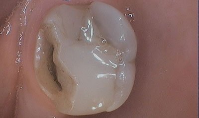 Bonding & Resin Composite Restorations case 13 — before