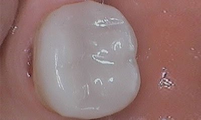 Bonding & Resin Composite Restorations case 13 — after