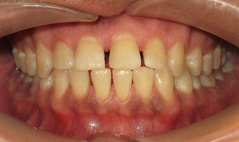 Bonding & Resin Composite Restorations case 130 — before