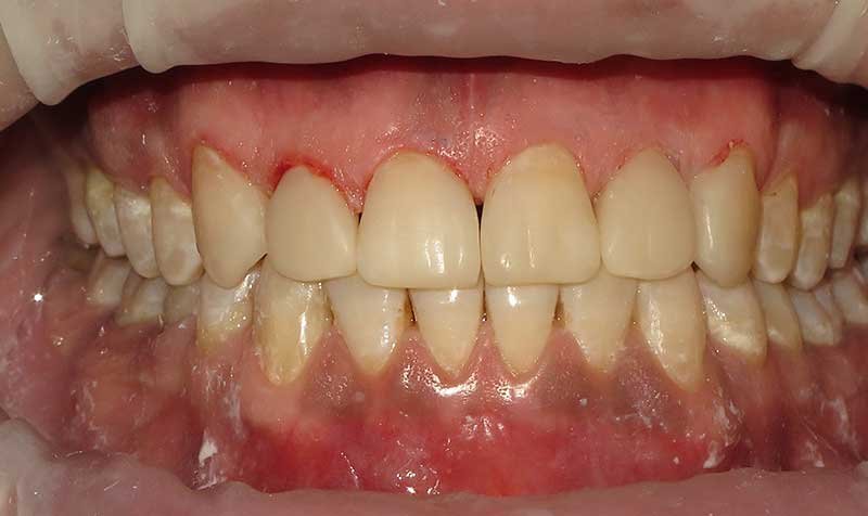 Bonding & Resin Composite Restorations case 130 — after