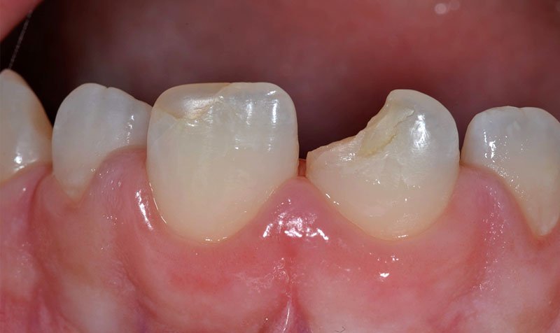 Bonding & Resin Composite Restorations case 134 — before