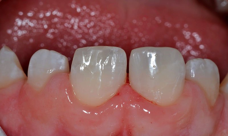 Bonding & Resin Composite Restorations case 134 — after