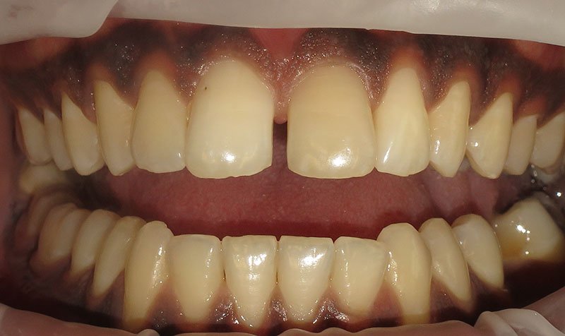 Bonding & Resin Composite Restorations case 135 — before
