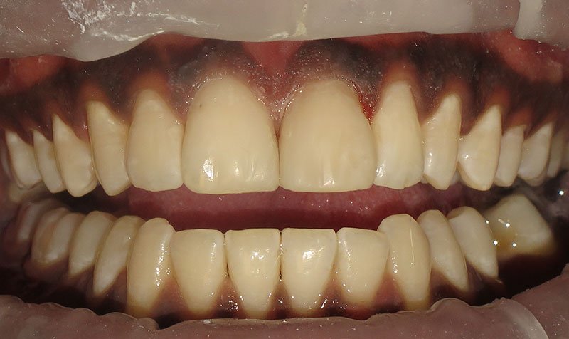 Bonding & Resin Composite Restorations case 135 — after