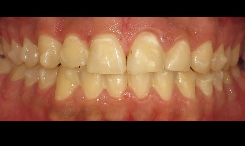 Bonding & Resin Composite Restorations case 138 — before