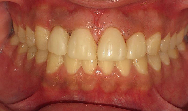 Bonding & Resin Composite Restorations case 138 — after