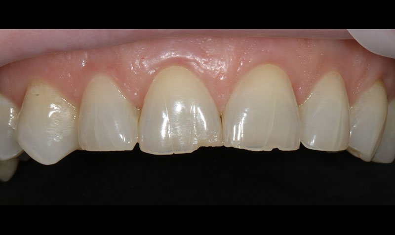 Bonding & Resin Composite Restorations case 139 — before