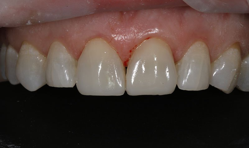 Bonding & Resin Composite Restorations case 139 — after
