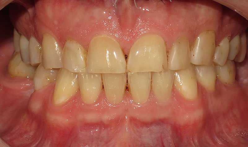 Bonding & Resin Composite Restorations case 141 — before