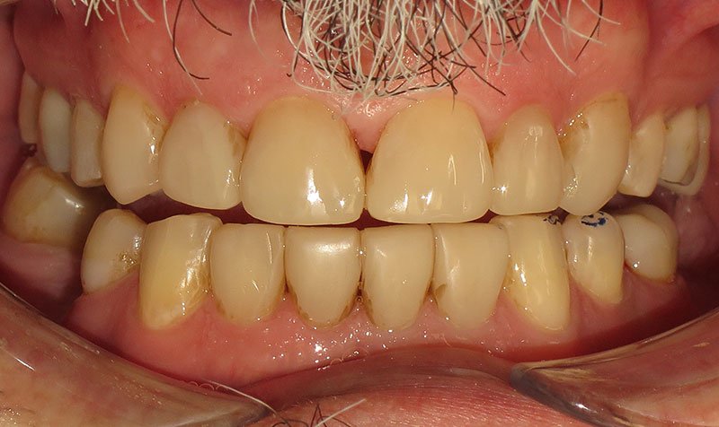 Bonding & Resin Composite Restorations case 141 — after