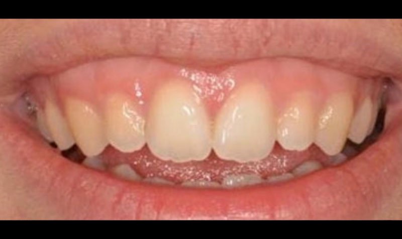 Bonding & Resin Composite Restorations case 146 — before