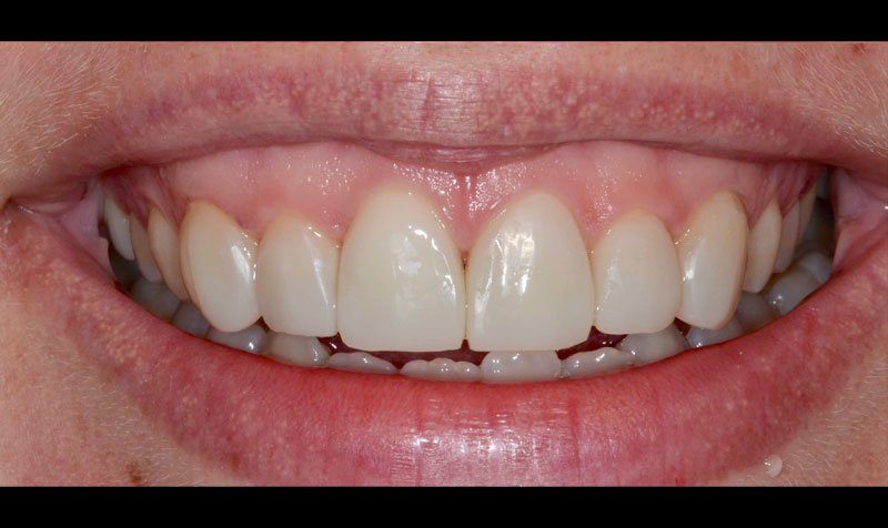 Bonding & Resin Composite Restorations case 146 — after