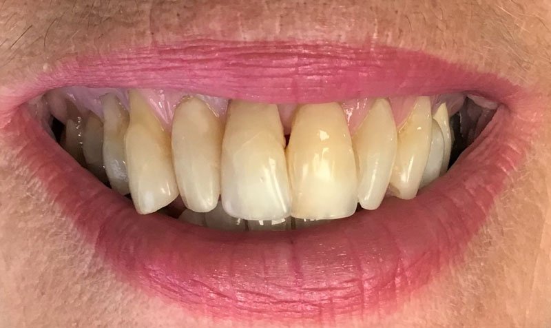 Bonding & Resin Composite Restorations case 147 — before