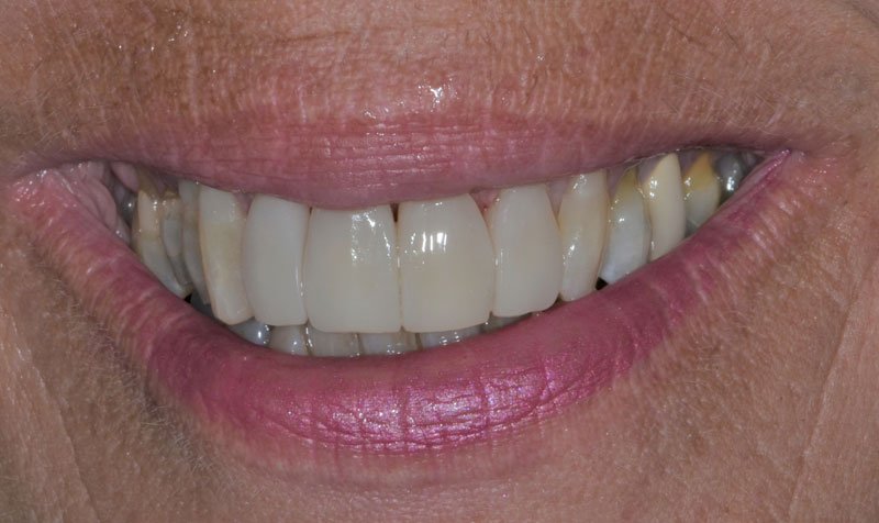 Bonding & Resin Composite Restorations case 147 — after