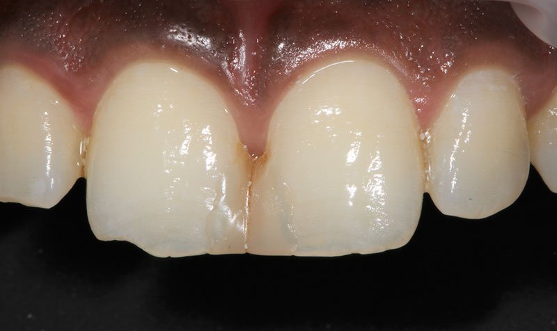 Bonding & Resin Composite Restorations case 149 — before