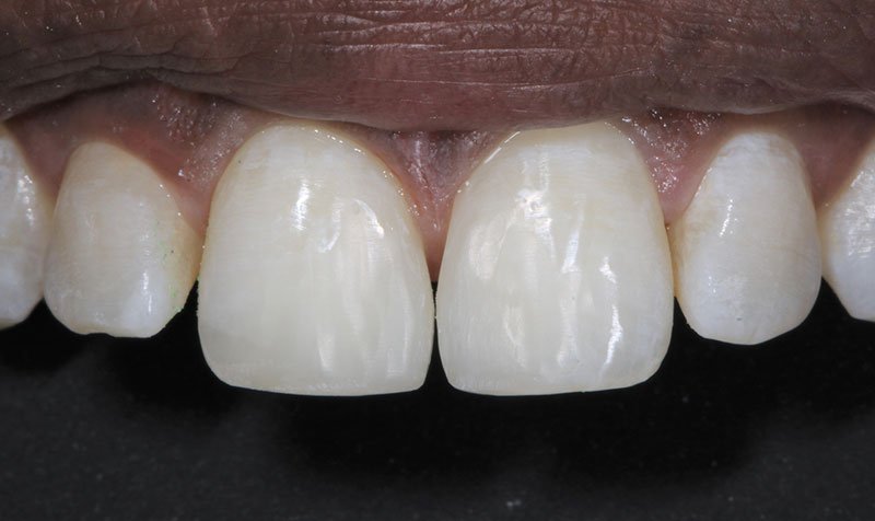 Bonding & Resin Composite Restorations case 149 — after