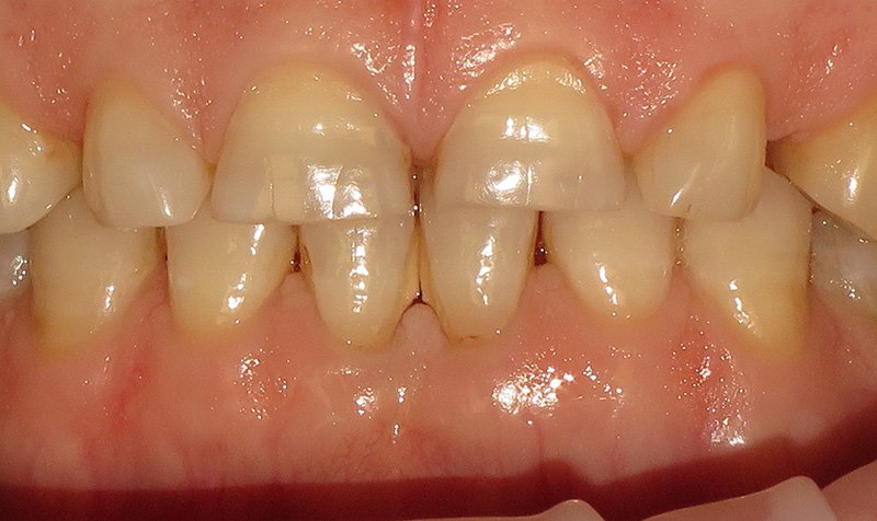 Bonding & Resin Composite Restorations case 153 — before
