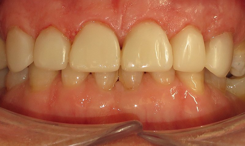 Bonding & Resin Composite Restorations case 153 — after