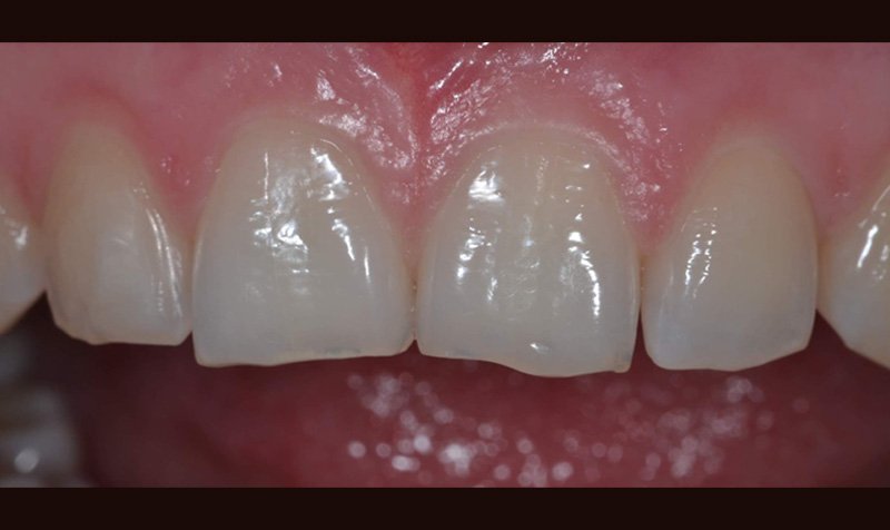 Bonding & Resin Composite Restorations case 157 — before