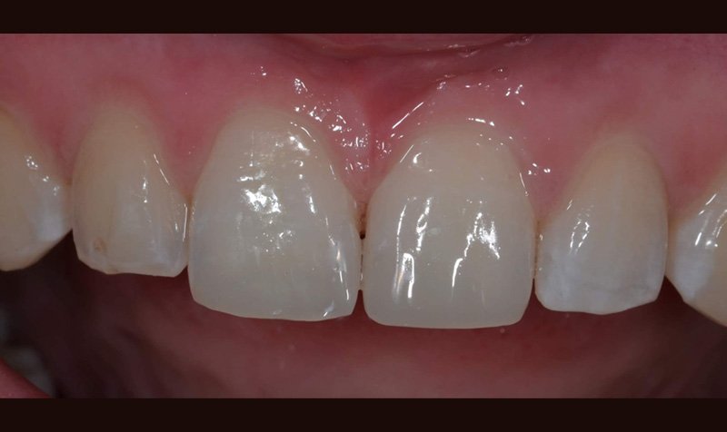 Bonding & Resin Composite Restorations case 157 — after