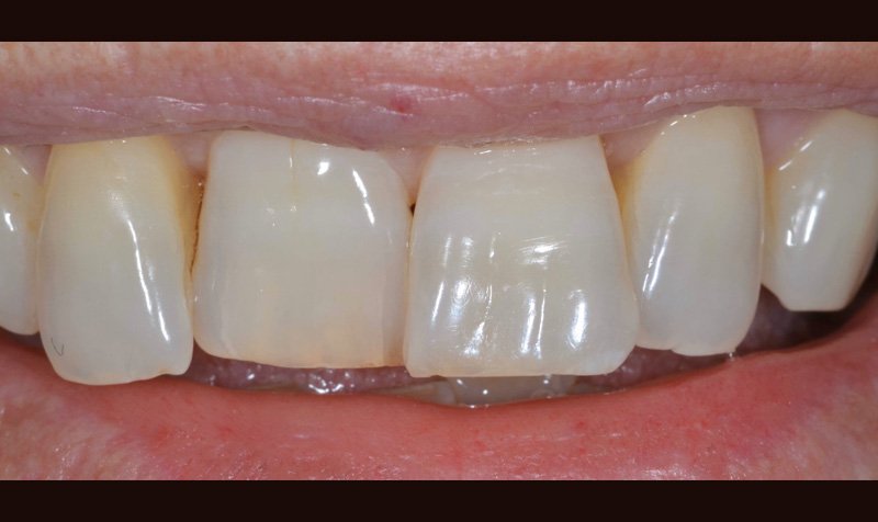 Bonding & Resin Composite Restorations case 158 — before