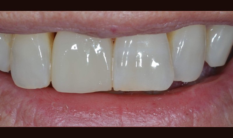 Bonding & Resin Composite Restorations case 158 — after