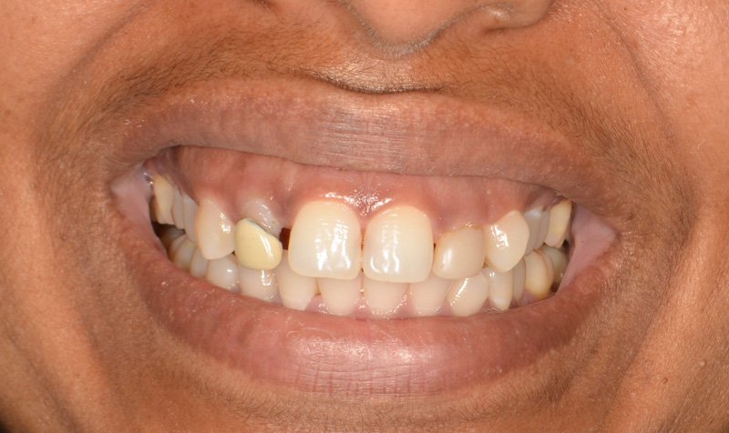 Bonding & Resin Composite Restorations case 159 — before