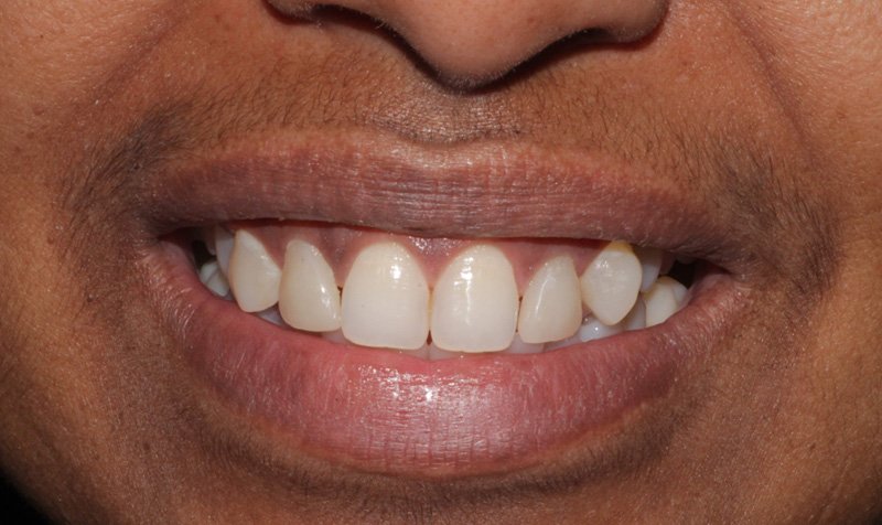 Bonding & Resin Composite Restorations case 159 — after